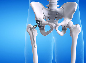 Dr. Mohit Shete Best Total Hip Replacement Surgeon in Mumbai & Thane
