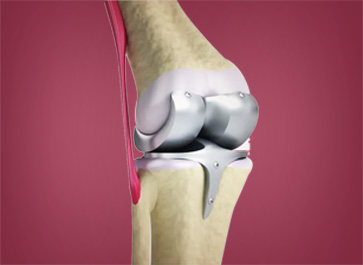 Dr. Mohit Shete Best Total Knee Replacement Surgeon in Mumbai & Thane